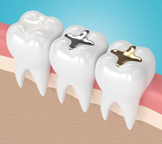 Houston Dental Sealants